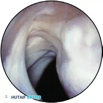 ESTABLISHING THE SUPERIOR PORTAL Surgical Diagram
