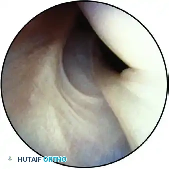 ESTABLISHING THE SUPERIOR PORTAL Surgical Diagram