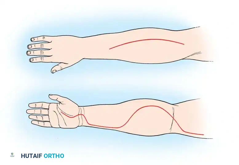 Acute Compartment Syndrome of the Upper Extremity: Pathophysiology, Diagnosis, and Surgical Decompression