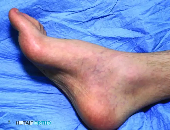 Cavovarus Foot Deformity: Etiology, Biomechanics, and Surgical Reconstruction