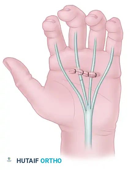 Masterclass in Flexor Tendon Examination and Advanced Repair Techniques