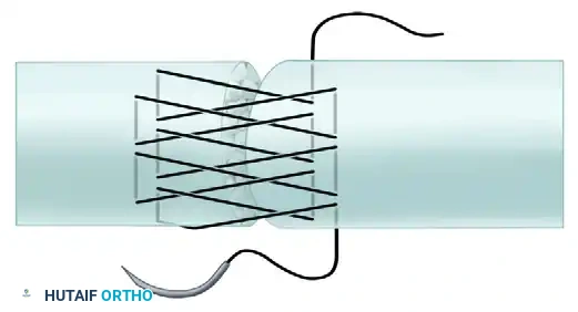 Advanced Suture Configuration