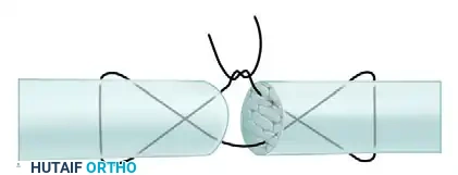 Advanced Suture Configuration