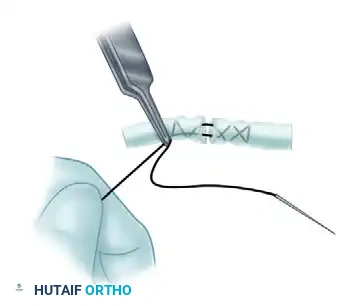 Advanced Suture Configuration