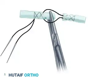 Advanced Suture Configuration