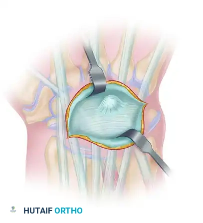 Excision of Dorsal and Volar Wrist Ganglions: A Comprehensive Surgical Guide