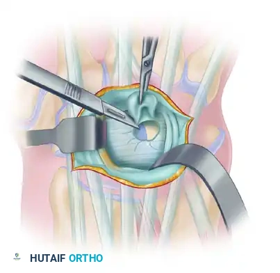 EXCISION OF A DORSAL WRIST GANGLION Surgical Diagram