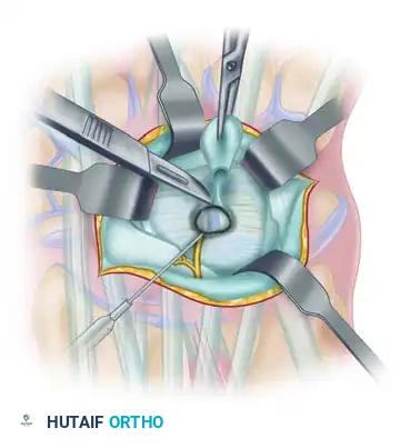 EXCISION OF A DORSAL WRIST GANGLION Surgical Diagram