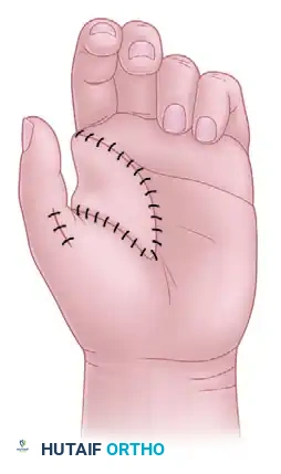 Excision of Extra Digit & Polydactyly Reconstruction