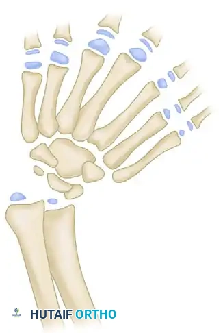 Pollicization and Osteotomy