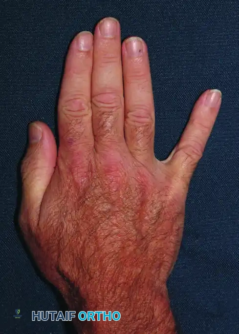 Surgical Management of Severe Forearm Contractures: Excision, Neurolysis, and Free Gracilis Transfer