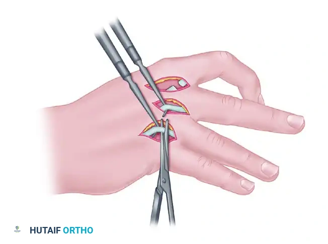 Stripping interosseous muscles