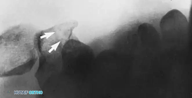 EXCISION OR REDUCTION AND FIXATION OF THE HOOK OF THE HAMATE Surgical Diagram