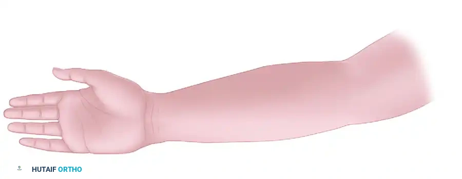 EXTENSIVE RELEASE OF THE FLEXOR PRONATOR ORIGIN Surgical Diagram