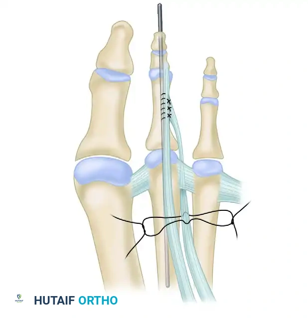 EXTENSOR DIGITORUM BREVIS TRANSFER FOR CROSSOVER TOE DEFORMITY Surgical Diagram