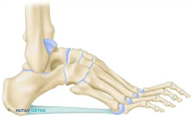 Cole Anterior Tarsal Wedge Osteotomy