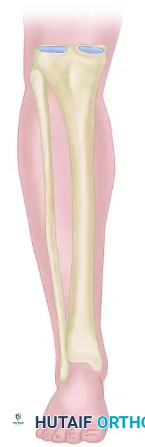 EXTERNAL FIXATION Surgical Diagram