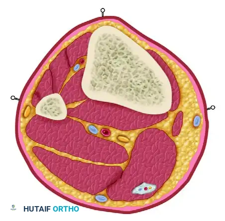 EXTERNAL FIXATION Surgical Diagram