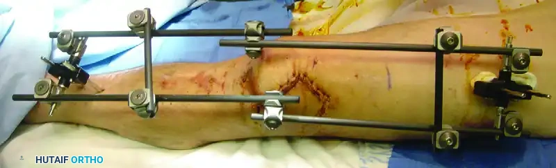 Masterclass in External Fixation: Principles, Biomechanics, and Surgical Techniques