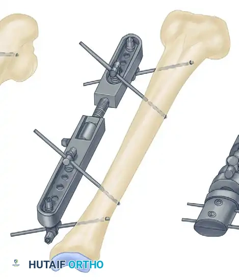 EXTERNAL FIXATION Surgical Diagram