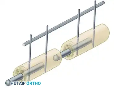 EXTERNAL FIXATION Surgical Diagram