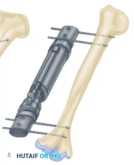 EXTERNAL FIXATION Surgical Diagram