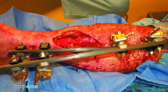 EXTERNAL FIXATION Surgical Diagram