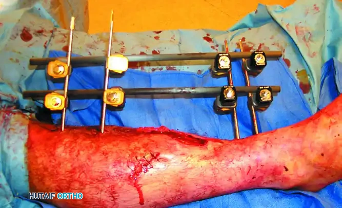 EXTERNAL FIXATION Surgical Diagram