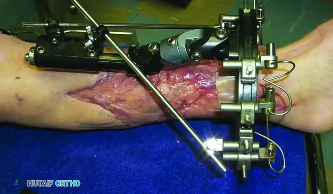 EXTERNAL FIXATION Surgical Diagram