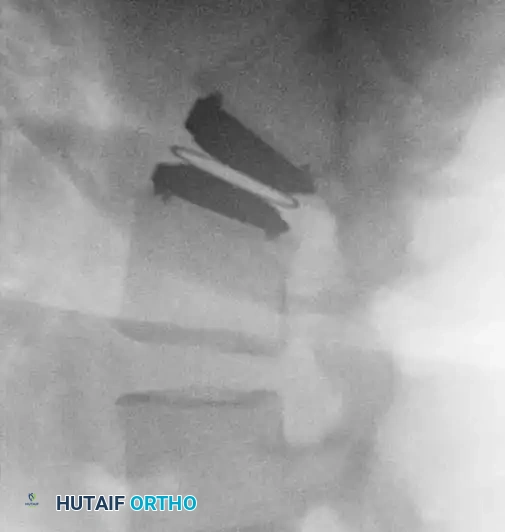 Fig. 39-47 A, Anteroposterior view of patient with internal disc derangement treated with Charité total disc replacement.