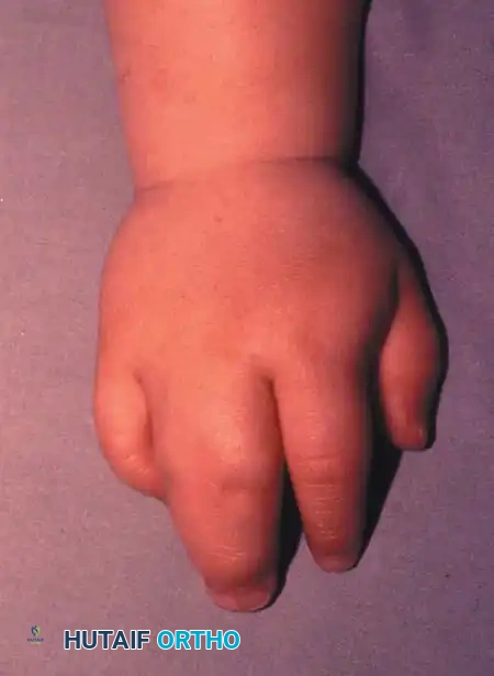 Syndactyly: Principles of Surgical Reconstruction and Management