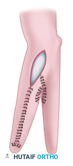 FAILURE OF FORMATION (ARREST OF DEVELOPMENT) Surgical Diagram