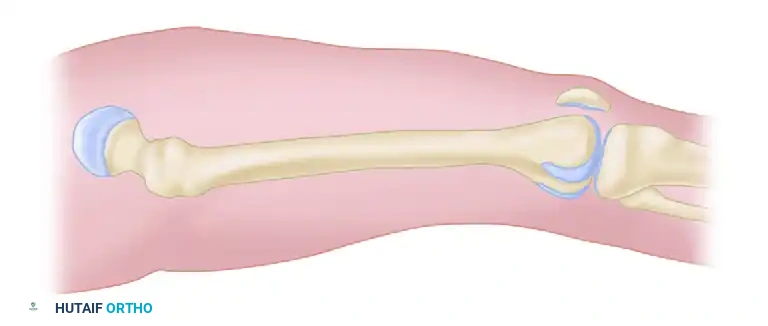 Fasciotomy for Acute Compartment Syndrome: Surgical Guide