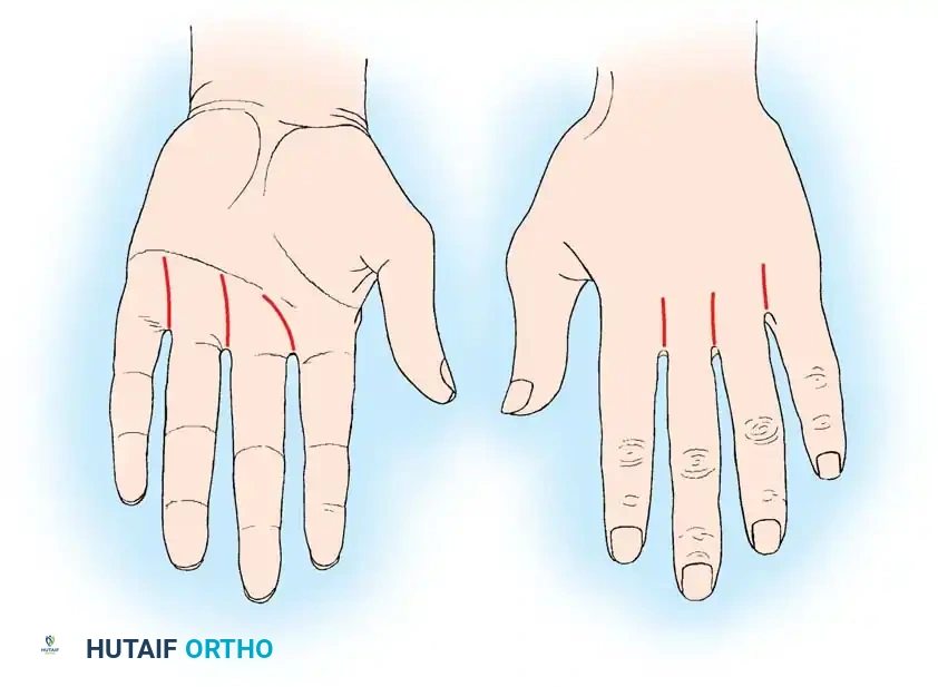 FELON Surgical Diagram