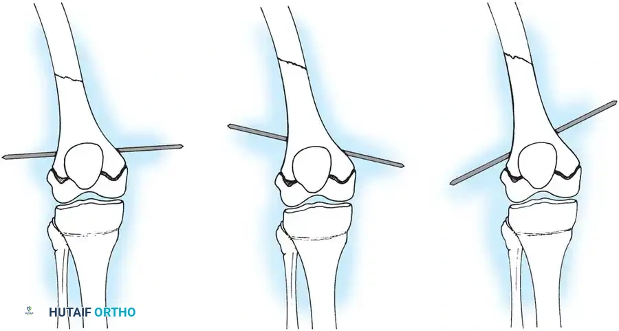 Traction Pin Placement