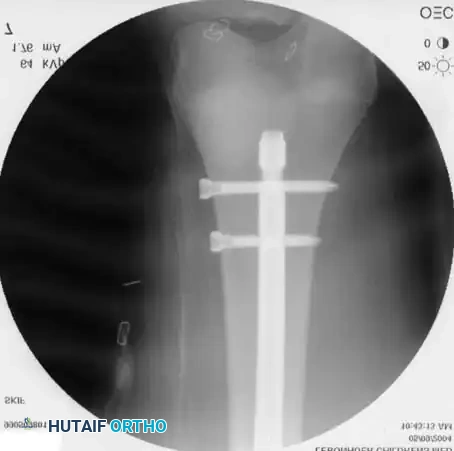 ESIN AP Radiograph