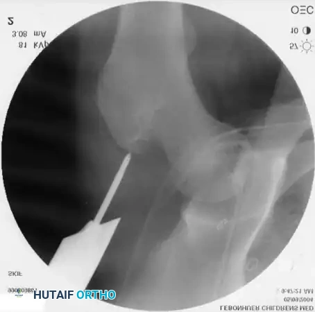 ESIN Callus Formation