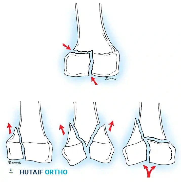 Rigid Nailing AP View