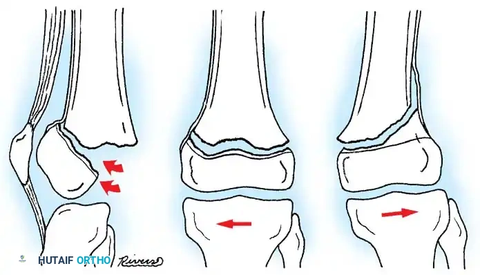 Rigid Nailing Lateral View