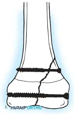 Rigid Nailing Distal Locking