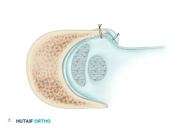 Fibular Groove Deepening, Superior Retinaculum Repair, and Management of Os Peroneum Syndrome