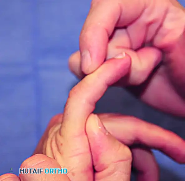 Rheumatoid Finger Deformities: Pathomechanics and Surgical Management