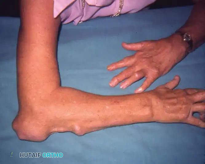 Rheumatoid Finger Deformities: Pathomechanics & Surgery