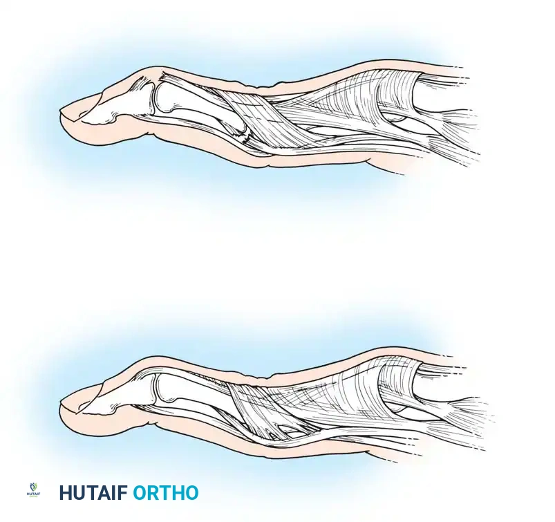Attenuated or ruptured extensor tendon