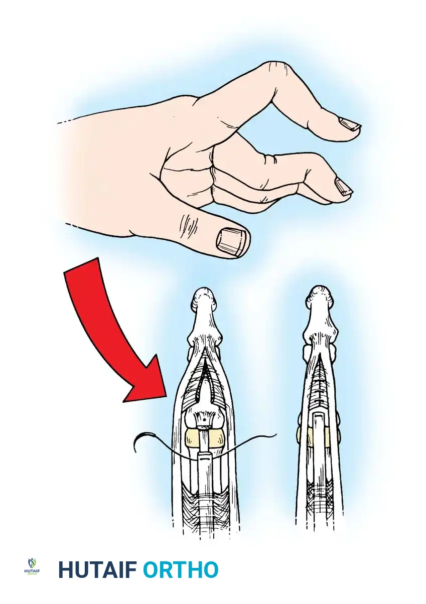 Volar zigzag incision