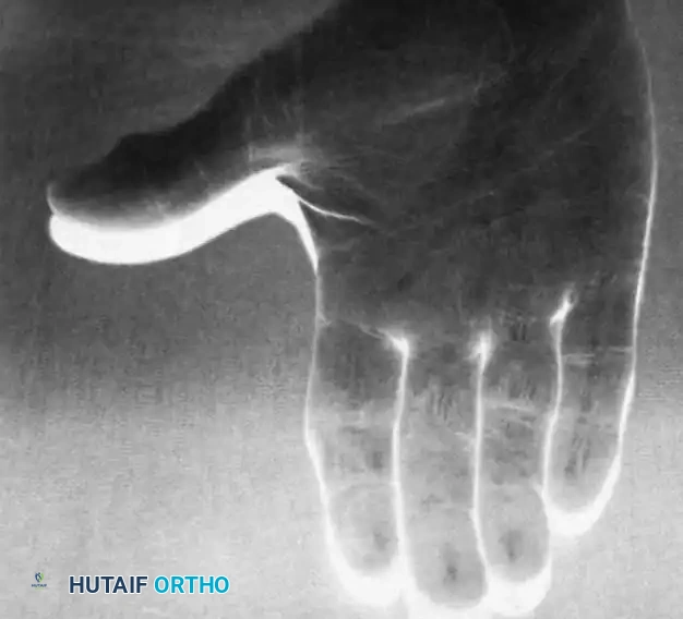 Puncturing the A2 pulley