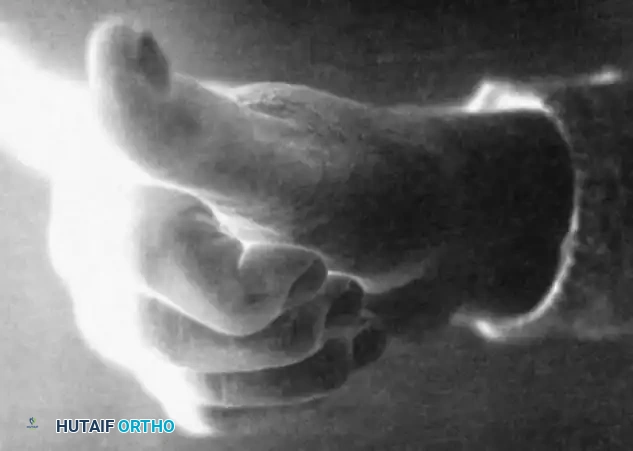 Splitting the FDS tendon