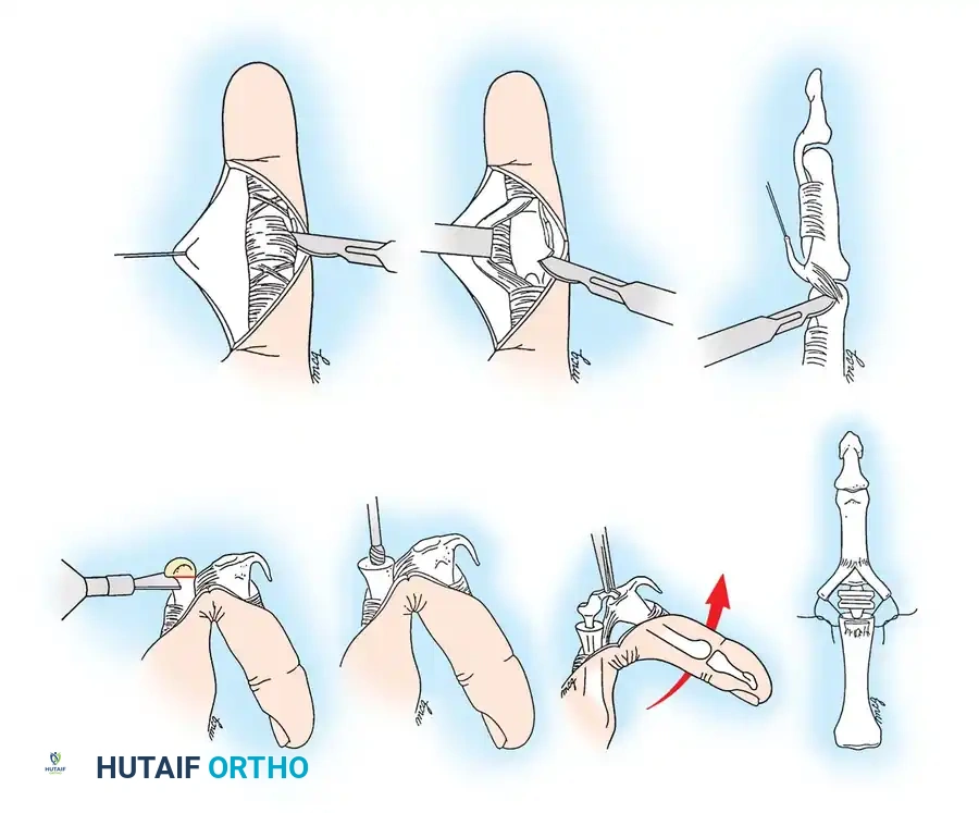 Passing the tendon slip