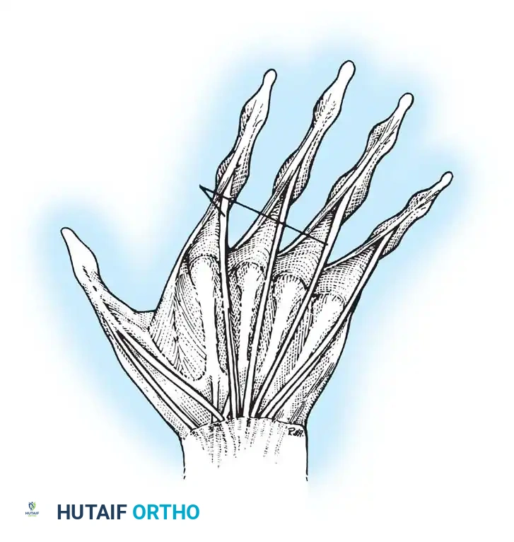 Suturing the tenodesis