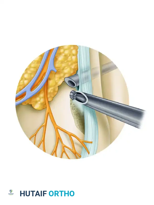 FIRST METATARSOPHALANGEAL JOINT ARTHROSCOPY Surgical Diagram